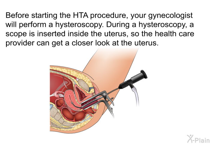Before starting the HTA procedure, your gynecologist will perform a hysteroscopy. During a hysteroscopy, a scope is inserted inside the uterus, so the health care provider can get a closer look at the uterus.