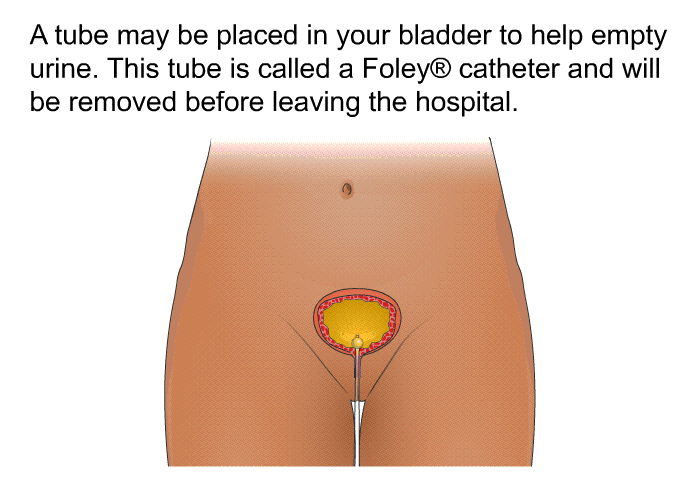 A tube may be placed in your bladder to help empty urine. This tube is called a Foley catheter and will be removed before leaving the hospital.