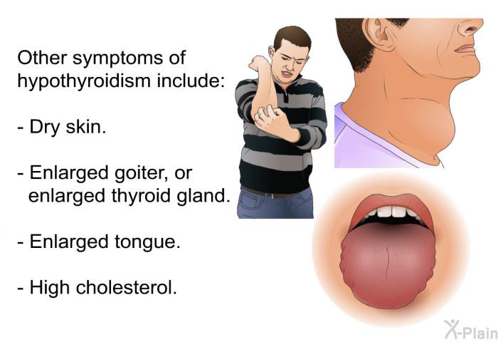 Other symptoms of hypothyroidism include:  Dry skin. Enlarged goiter, or enlarged thyroid gland. Enlarged tongue. High cholesterol.