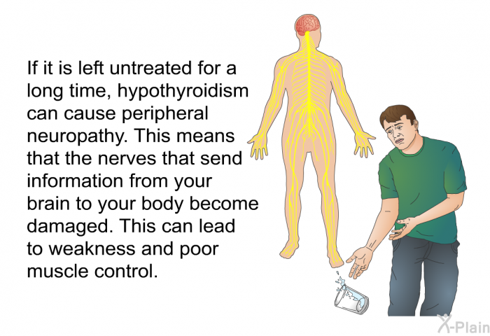 If it is left untreated for a long time, hypothyroidism can cause peripheral neuropathy. This means that the nerves that send information from your brain to your body become damaged. This can lead to weakness and poor muscle control.
