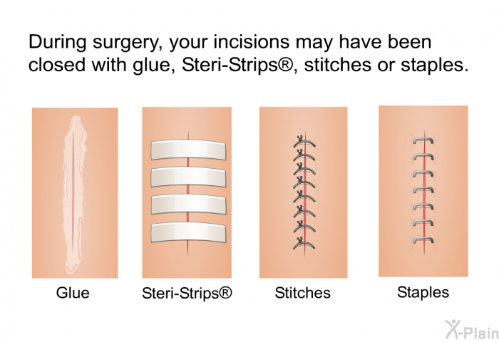 During surgery, your incisions may have been closed with glue, Steri-Strips , stitches or staples.