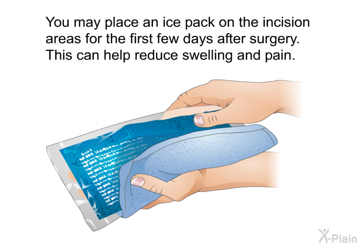 You may place an ice pack on the incision areas for the first few days after surgery. This can help reduce swelling and pain.