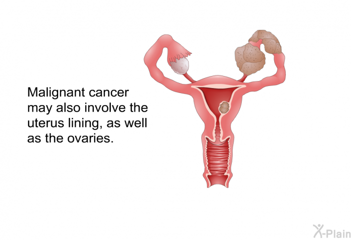 Malignant cancer may also involve the uterus lining, as well as the ovaries.