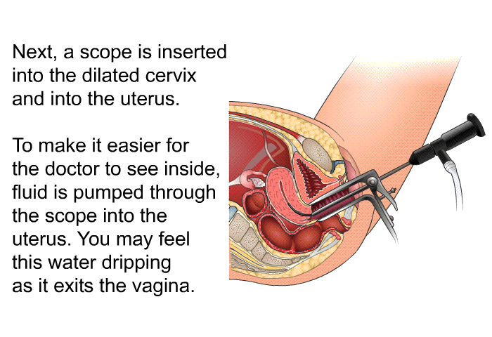 Next, a scope is inserted into the dilated cervix and into the uterus. To make it easier for the doctor to see inside, fluid is pumped through the scope into the uterus. You may feel this water dripping as it exits the vagina.