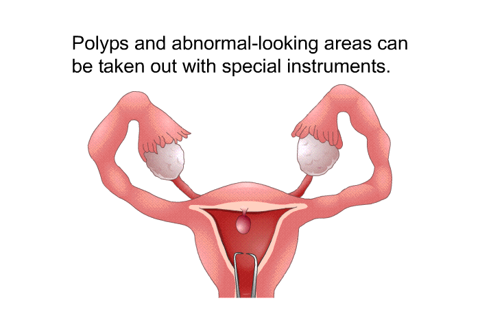 Polyps and abnormal-looking areas can be taken out with special instruments.