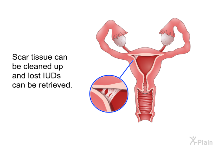 Scar tissue can be cleaned up and lost IUDs can be retrieved.