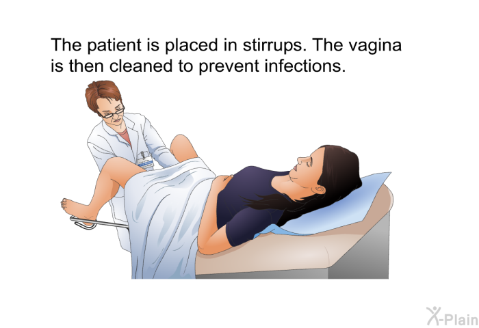 The patient is placed in stirrups. The vagina is then cleaned to prevent infections.