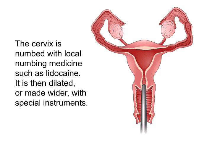 The cervix is numbed with local numbing medicine such as lidocaine. It is then dilated, or made wider, with special instruments.