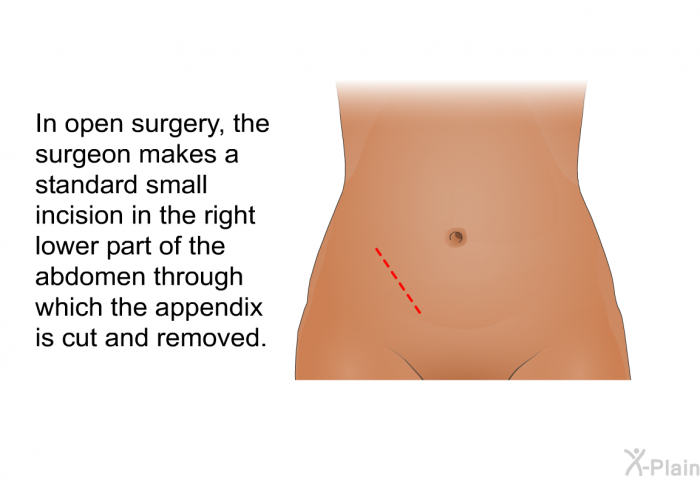 In open surgery, the surgeon makes a standard small incision in the right lower part of the abdomen through which the appendix is cut and removed.