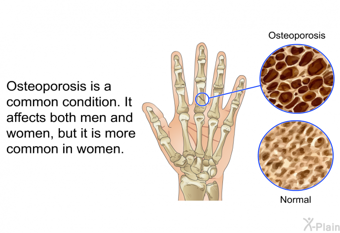 Osteoporosis is a common condition. It affects both men and women, but it is more common in women.