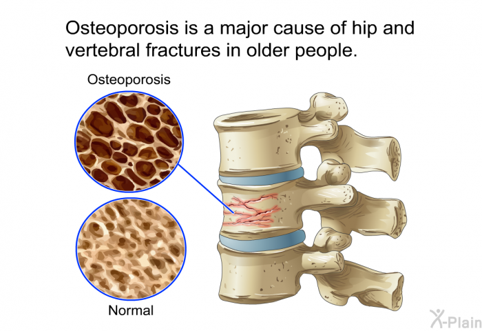 Osteoporosis is a major cause of hip and vertebral fractures in older people.