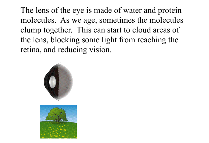 The lens of the eye is made of water and protein molecules. As we age, sometimes the molecules clump together. This can start to cloud areas of the lens, blocking some light from reaching the retina, and reducing vision.
