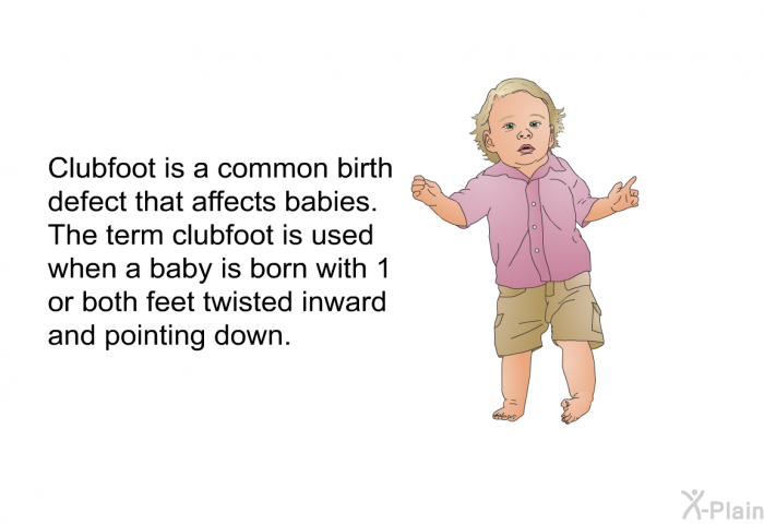Clubfoot is a common birth defect that affects babies. The term clubfoot is used when a baby is born with 1 or both feet twisted inward and pointing down.