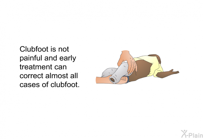 Clubfoot is not painful and early treatment can correct almost all cases of clubfoot.