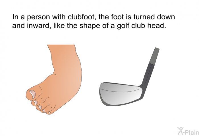 In a person with clubfoot, the foot is turned down and inward, like the shape of a golf club head.