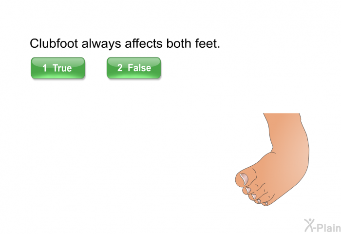 Clubfoot always affects both feet.