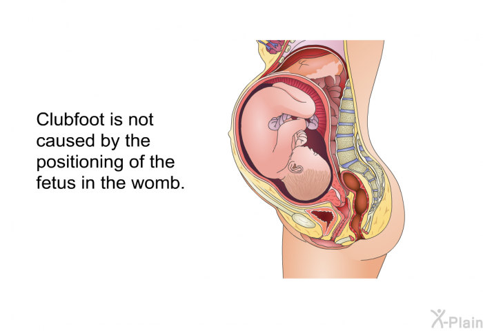 Clubfoot is not caused by the positioning of the fetus in the womb.