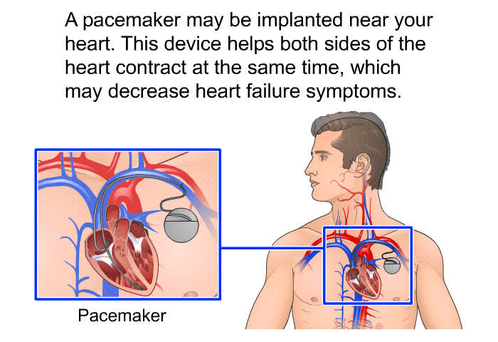 A pacemaker may be implanted near your heart. This device helps both sides of the heart contract at the same time, which may decrease heart failure symptoms.