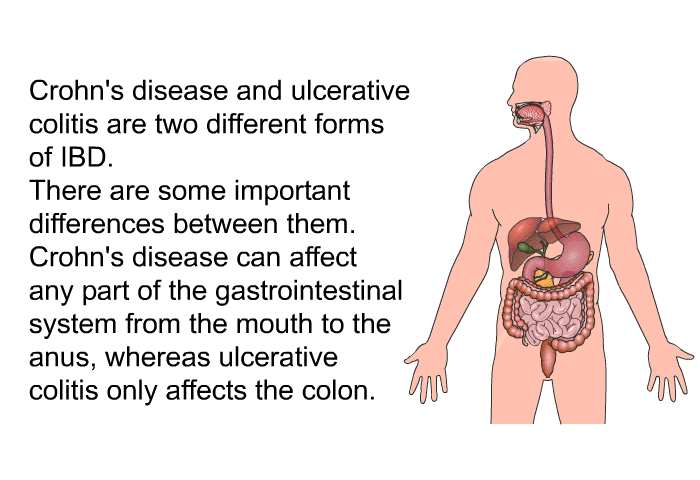 Crohn's disease and ulcerative colitis are two different forms of IBD. There are some important differences between them. Crohn's disease can affect any part of the gastrointestinal system from the mouth to the anus, whereas ulcerative colitis only affects the colon.