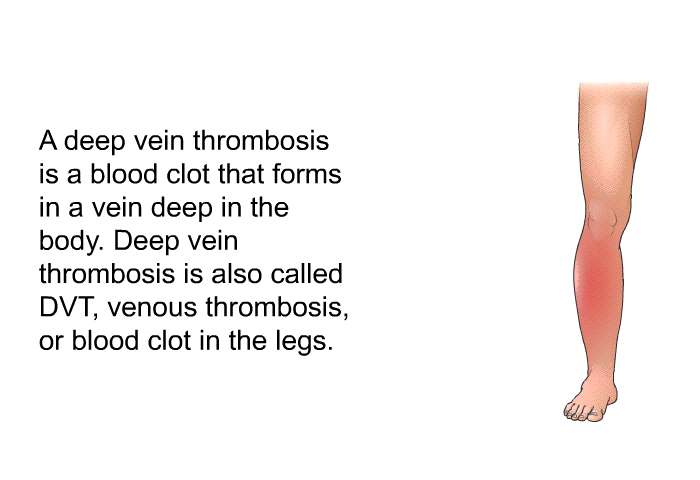 A deep vein thrombosis is a blood clot that forms in a vein deep in the body. Deep vein thrombosis is also called DVT, venous thrombosis, or blood clot in the legs.