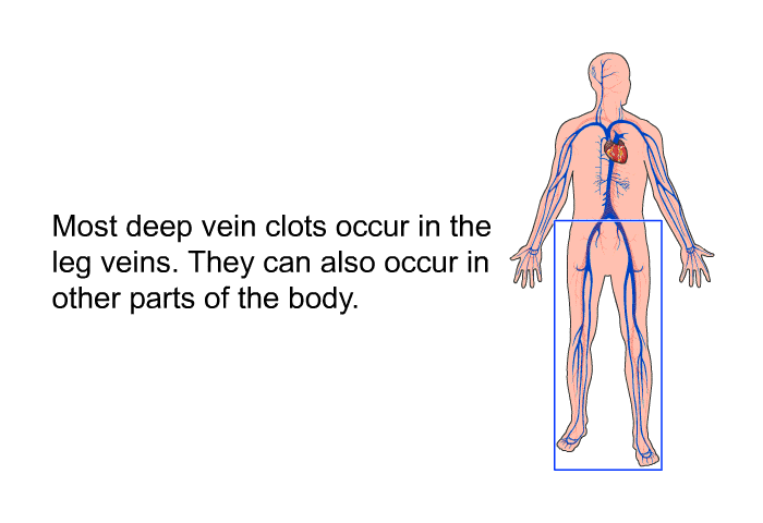PatEdu Deep Vein Thrombosis