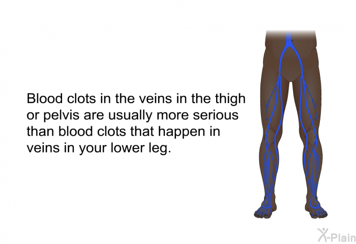 Blood clots in the veins in the thigh or pelvis are usually more serious than blood clots that happen in veins in your lower leg.