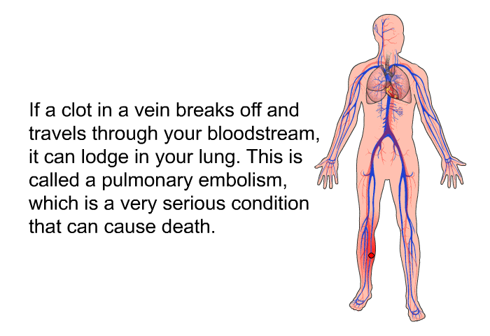 If a clot in a vein breaks off and travels through your bloodstream, it can lodge in your lung. This is called a pulmonary embolism, which is a very serious condition that can cause death.