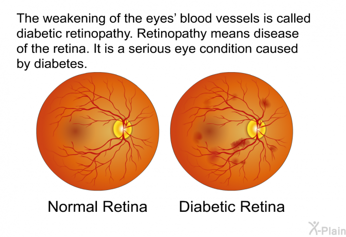 The weakening of the eyes' blood vessels is called diabetic retinopathy. Retinopathy means disease of the retina. It is a serious eye condition caused by diabetes.