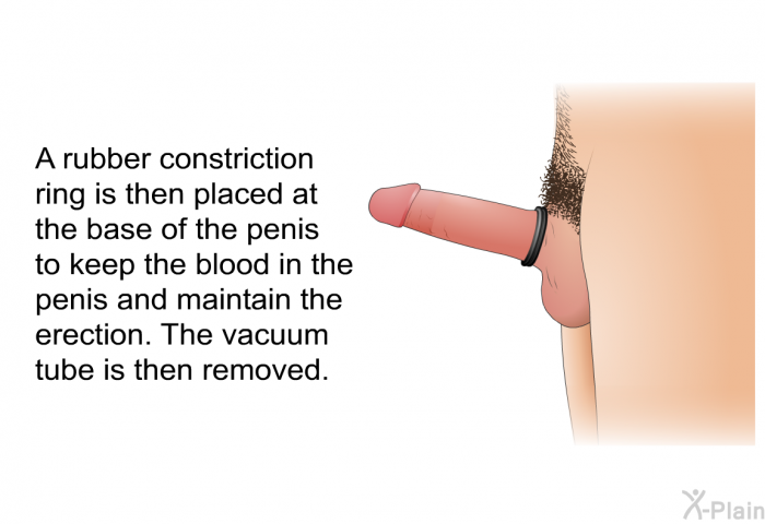 A rubber constriction ring is then placed at the base of the penis to keep the blood in the penis and maintain the erection. The vacuum tube is then removed.