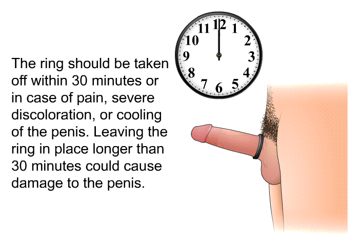 The ring should be taken off within 30 minutes or in case of pain, severe discoloration, or cooling of the penis. Leaving the ring in place longer than 30 minutes could cause damage to the penis.