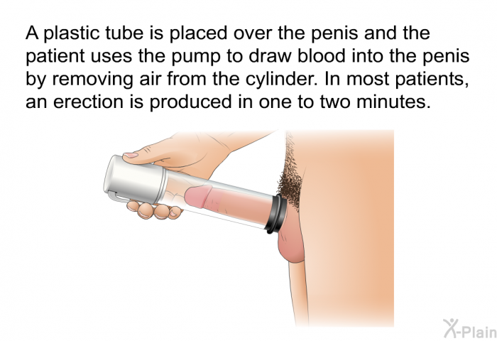 A plastic tube is placed over the penis and the patient uses the pump to draw blood into the penis by removing air from the cylinder. In most patients, an erection is produced in one to two minutes.