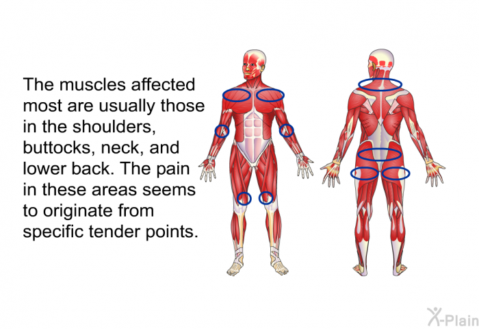 The muscles affected most are usually those in the shoulders, buttocks, neck, and lower back. The pain in these areas seems to originate from specific tender points.