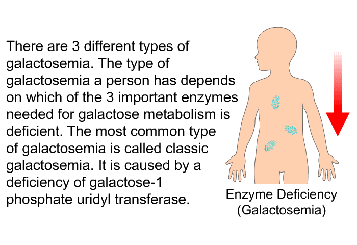 There are 3 different types of galactosemia. The type of galactosemia a person has depends on which of the 3 important enzymes needed for galactose metabolism is deficient. The most common type of galactosemia is called classic galactosemia. It is caused by a deficiency of galactose-1 phosphate uridyl transferase.