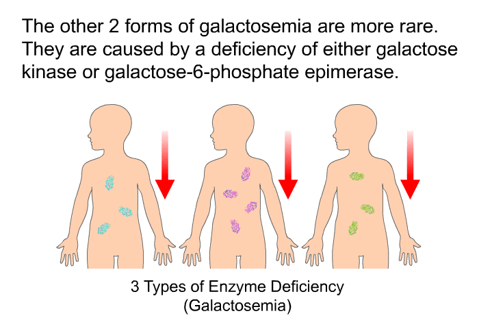 The other 2 forms of galactosemia are more rare. They are caused by a deficiency of either galactose kinase or galactose-6-phosphate epimerase.