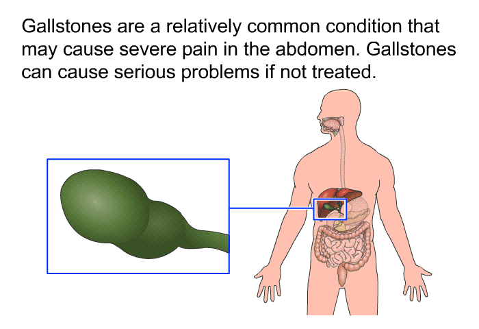 Gallstones are a relatively common condition that may cause severe pain in the abdomen. Gallstones can cause serious problems if not treated.