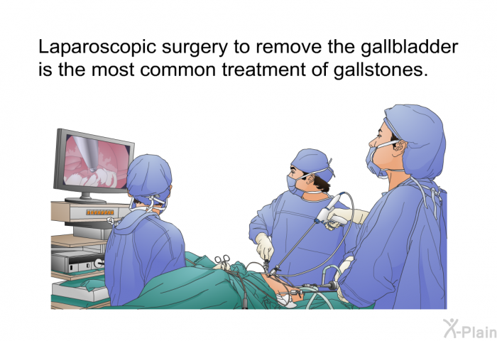 Laparoscopic surgery to remove the gallbladder is the most common treatment of gallstones.