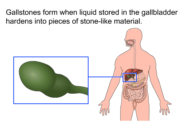 Gallstones form when liquid stored in the gallbladder hardens into pieces of stone-like material.