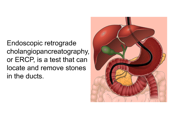 Endoscopic retrograde cholangiopancreatography, or ERCP, is a test that can locate and remove stones in the ducts.