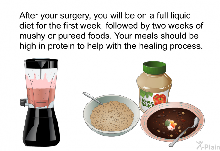 After your surgery, you will be on a full liquid diet for the first week, followed by two weeks of mushy or pureed foods. Your meals should be high in protein to help with the healing process.