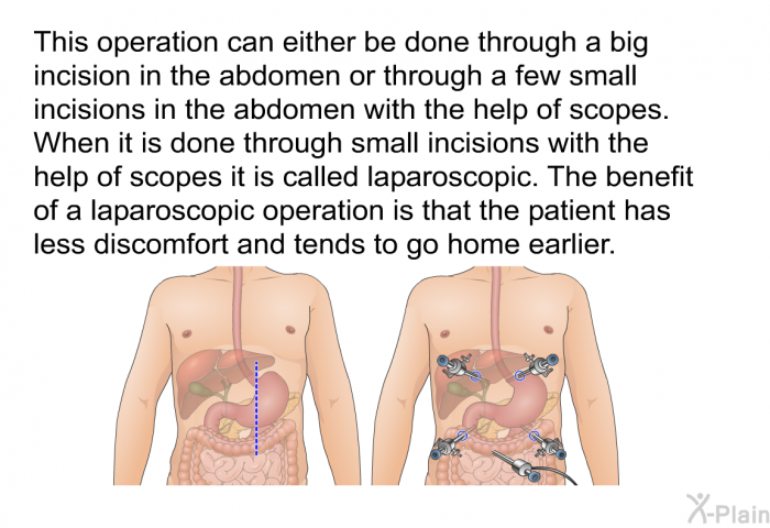 This operation can either be done through a big incision in the abdomen or through a few small incisions in the abdomen with the help of scopes. When it is done through small incisions with the help of scopes it is called laparoscopic. The benefit of a laparoscopic operation is that the patient has less discomfort and tends to go home earlier.