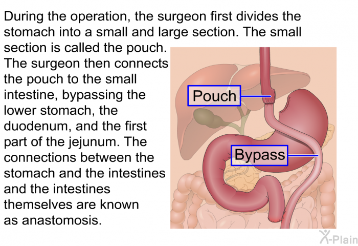 During the operation, the surgeon first divides the stomach into small and a large section. The small section is called the pouch. The surgeon then connects the pouch to the small intestine, bypassing the lower stomach, the duodenum, and the first part of the jejunum. The connections between the stomach and the intestines and the intestines themselves are known as anastomosis.