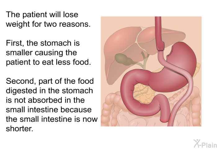 The patient will lose weight for two reasons. First, the stomach is smaller causing the patient to eat less food. Second, part of the food digested in the stomach is not absorbed in the small intestine because the small intestine is now shorter.