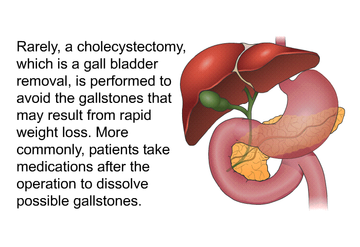 Rarely, a cholecystectomy which is a gall bladder removal is performed to avoid the gallstones that may result from rapid weight loss. More commonly, patients take medications after the operation to dissolve possible gallstones.