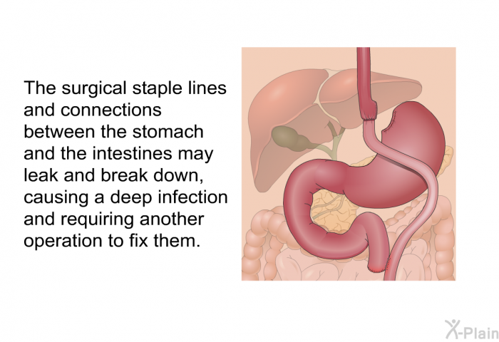 The surgical staple lines and connections between the stomach and the intestines may leak and break down, causing a deep infection and<B> </B>requiring another operation to fix them.