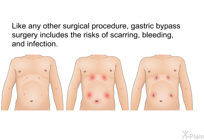 Like any other surgical procedure, gastric bypass surgery includes the risks of scarring, bleeding, and infection.