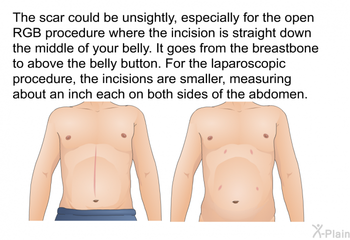 The scar could be unsightly, especially for the open RGB procedure where the incision is straight down the middle of your belly. It goes from the breastbone to above the belly button. For the laparoscopic procedure, the incisions are smaller, measuring about an inch each on both sides of the abdomen.