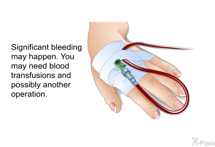 Significant bleeding may happen. You may need blood transfusions and possibly another operation.