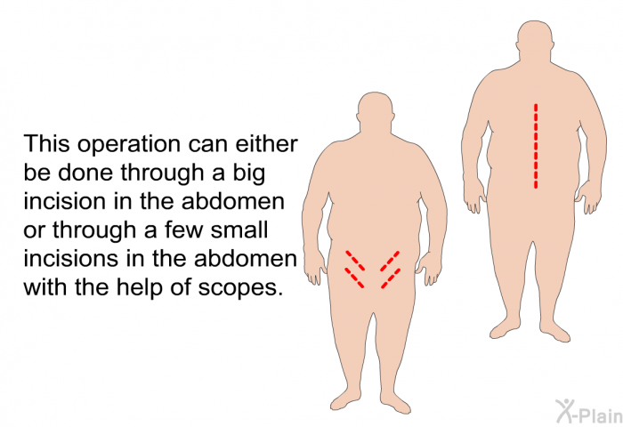 This operation can either be done through a big incision in the abdomen or through a few small incisions in the abdomen with the help of scopes.