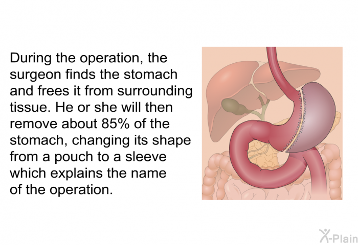 During the operation, the surgeon finds the stomach and frees it from surrounding tissue. He or she will then remove about 85% of the stomach, changing its shape from a pouch to a sleeve which explains the name of the operation.