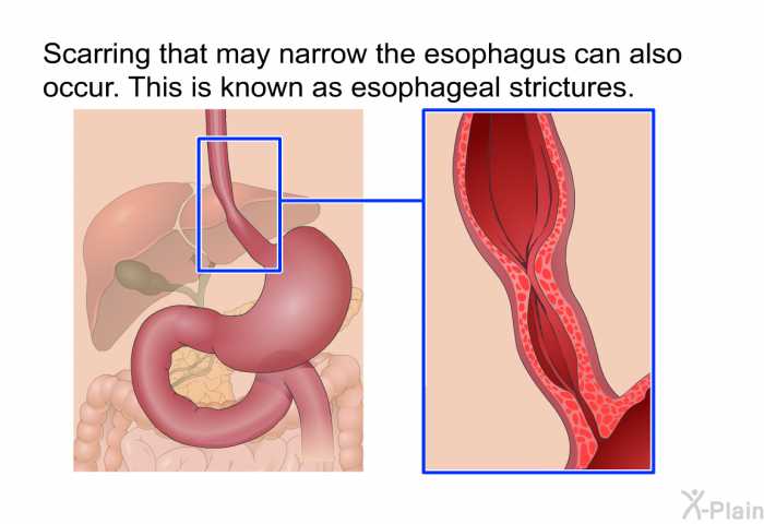 Scarring that may narrow the esophagus can also occur. This is known as esophageal strictures.
